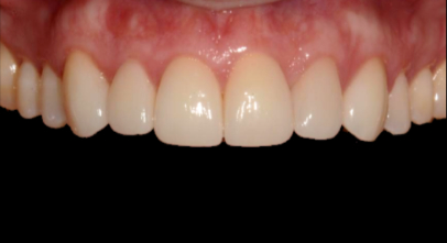 Patient after Invisalign procedure