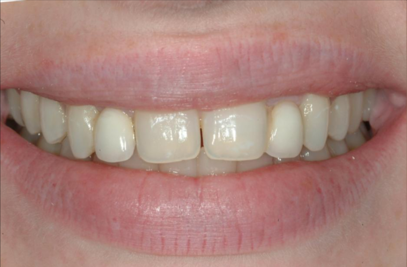 Patient before smile makeover procedure