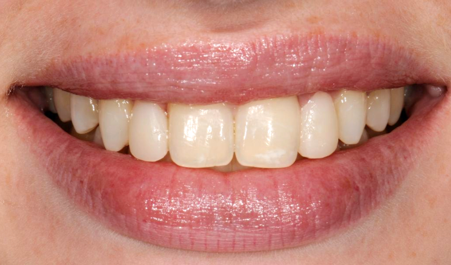 Patient after smile makeover procedure