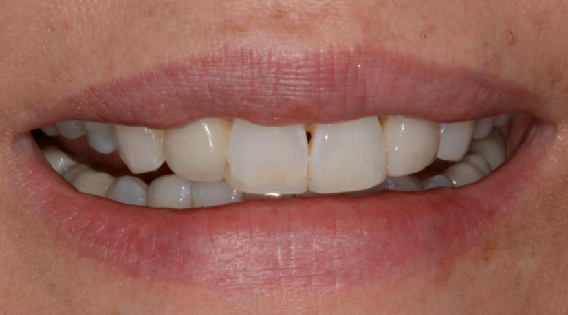 Patient before smile makeover procedure