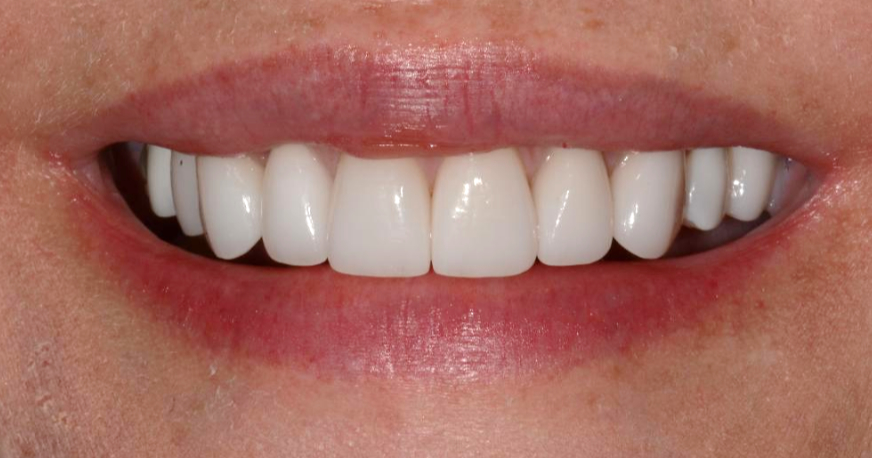 Patient after smile makeover procedure