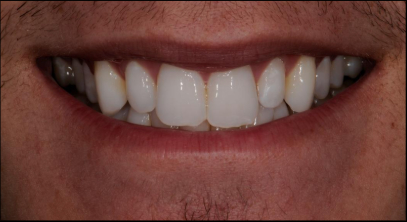 Patient before veneers procedure