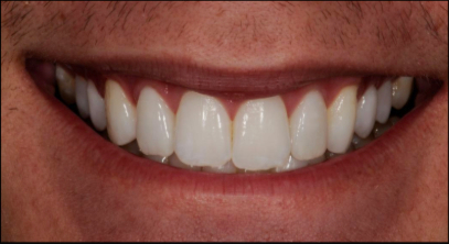 Close-up of a person's mouth showing clean, straight, and white teeth in a smile.