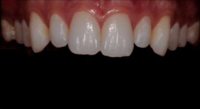 Patient before veneers procedure