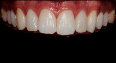 A close-up view of clean, straight upper and lower teeth with healthy gums visible.