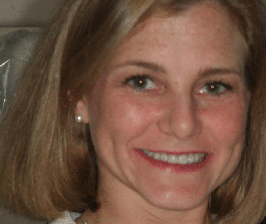 Patient before veneers procedure