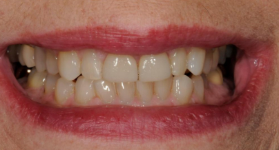 Patient before veneers procedure