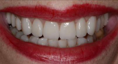 A close-up of a person's mouth with bright red lipstick and straight, white teeth, showing both upper and lower dental arches.