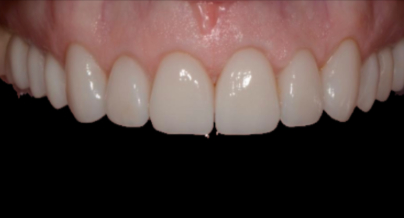 Patient after veneers procedure