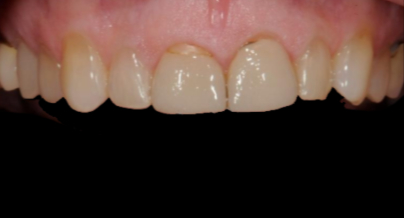 Patient before veneers procedure