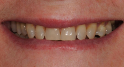 Patient before veneers procedure