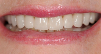 Patient after veneers procedure