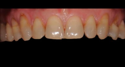 Patient before veneers procedure