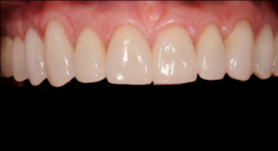 Patient after veneers procedure