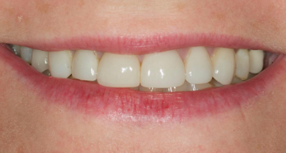 Patient before veneers procedure
