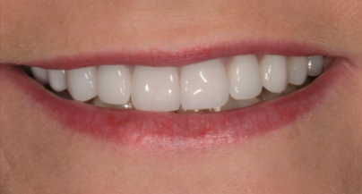 Patient after veneers procedure