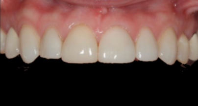 Patient before veneers procedure