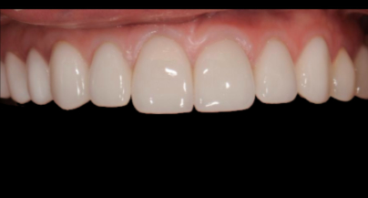 Patient after veneers procedure