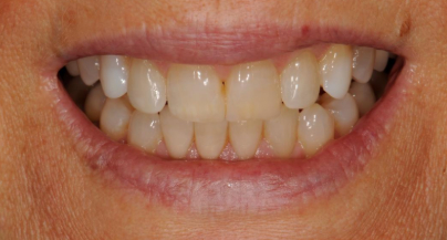 Patient before veneers procedure
