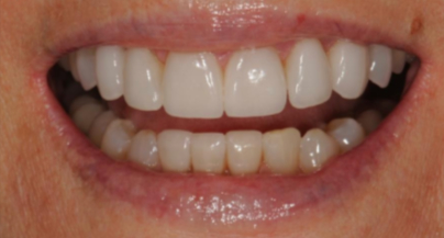 Patient after veneers procedure