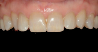 Patient before veneers procedure
