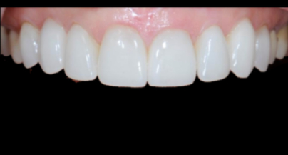 Patient after veneers procedure