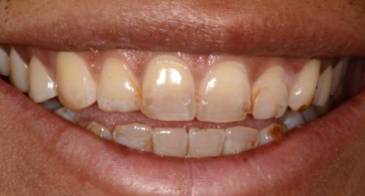 Patient before veneers procedure