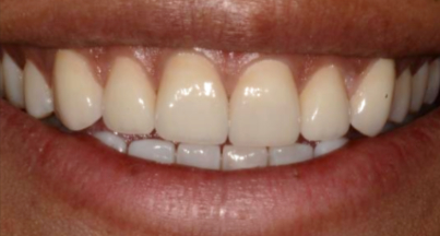Patient after veneers procedure