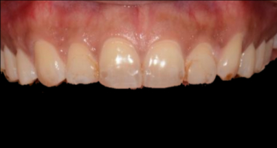 Patient before veneers procedure