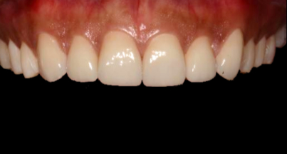 Patient after veneers procedure