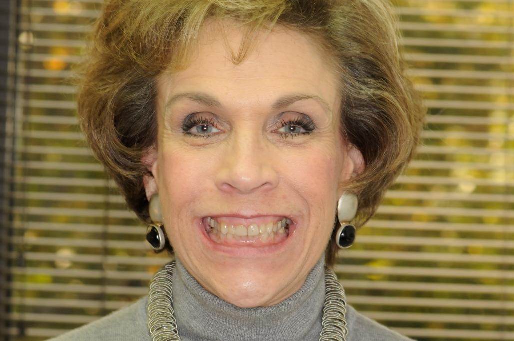 Patient before veneers procedure