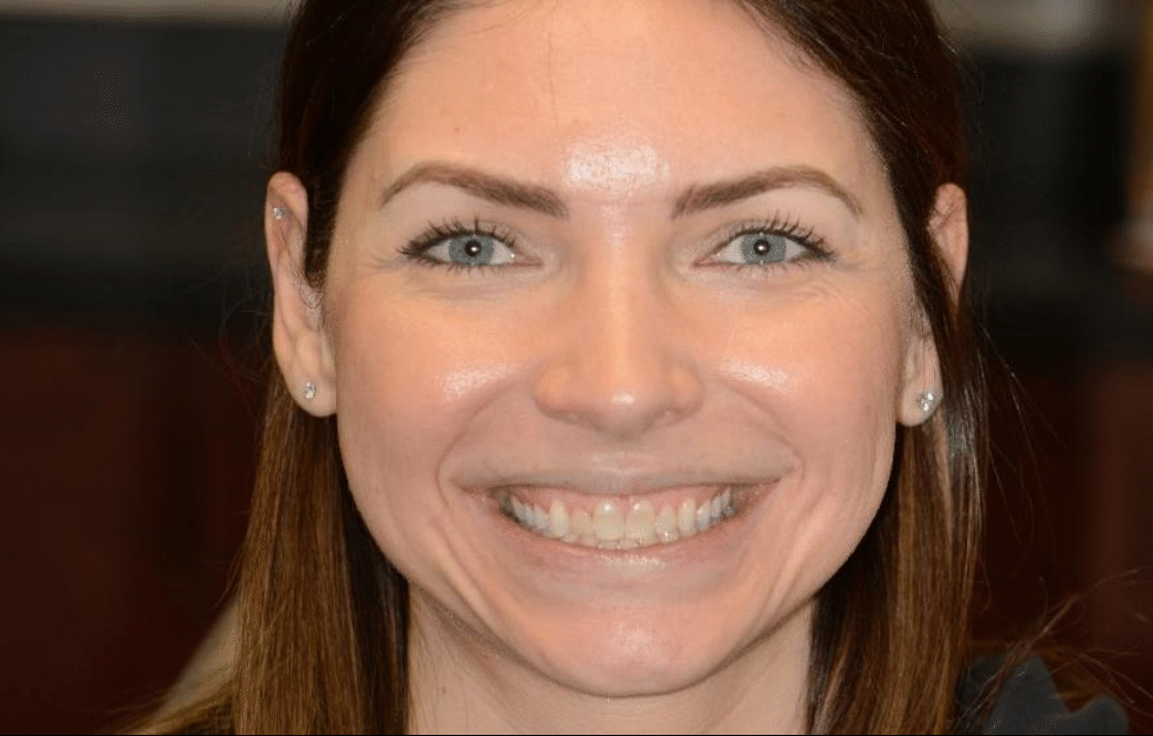 Patient before veneers procedure