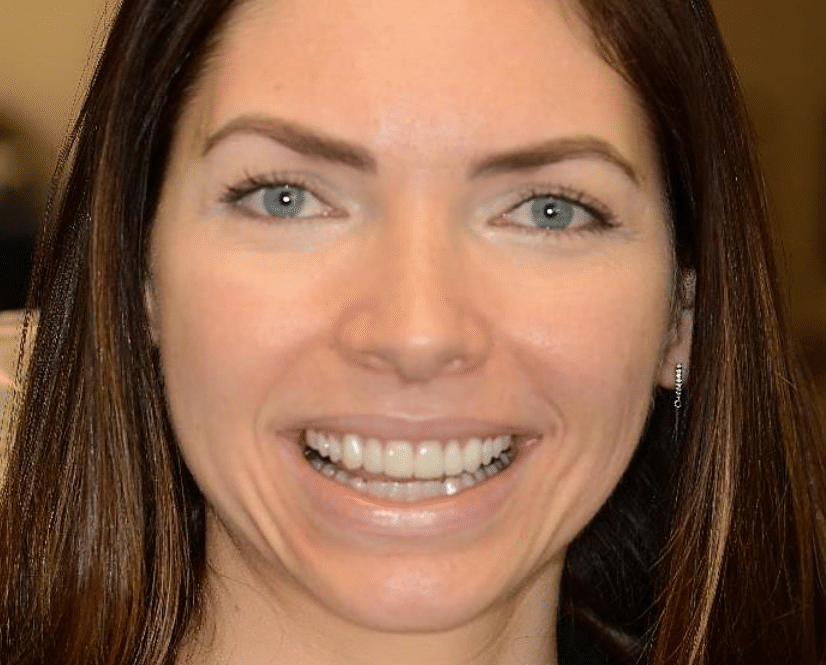 Patient after veneers procedure