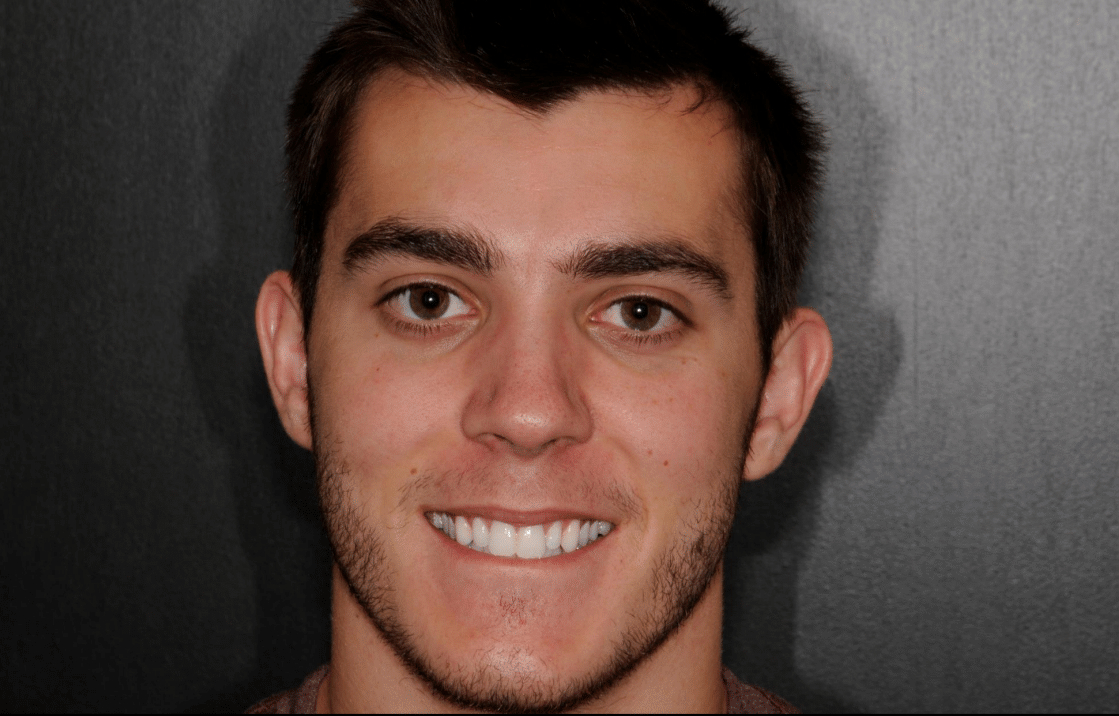 Patient before veneers procedure