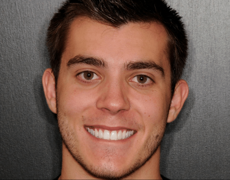 Patient after veneers procedure